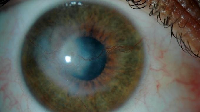 Leucoma corneal